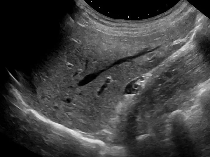 Ultrasound of a normal liver, with the vessels a vision model picks up highlighted